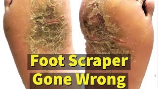 Extreme dry cracked feet skin removal after treatment [upl. by Toomay267]