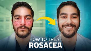 NEW Acne Laser Treatment Explained  Aviclear [upl. by Aissila]