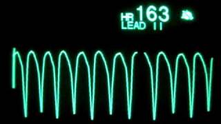 Ventricular Tachycardia [upl. by Reggie]