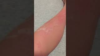 Skin Peeling from Sunburn asmr [upl. by Monto]