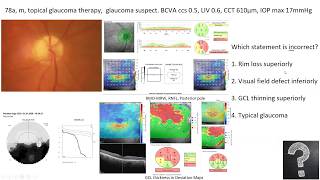 Lecture Using OCT as an Approach to Diagnose Glaucomatous and Other Optic Neuropathies [upl. by Atnauqal]