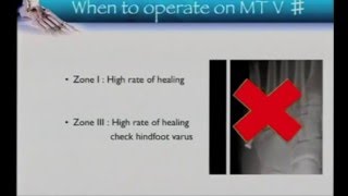 5th Metatarsal fractures [upl. by Cozmo]