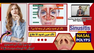 Sinusitis Explained Causes Symptoms and Remedies  Naak Kay Ghadood  Naak Ki Haddi Ka Operation [upl. by Rednazxela]