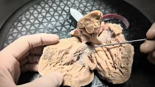 Specimen walkthrough 11 Double inlet left ventricle Cardiac anatomy cardiac pathology [upl. by Nialb]