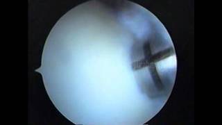 Knee arthroscopy  OCD Mosaicplasty [upl. by Colpin]