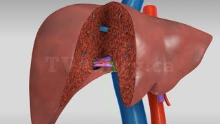 Liver transplant Living donor right hepatectomy donor procedure [upl. by Rowe779]