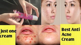 Best anti acne cream in pakistan quot best anti acne cream for all skin type [upl. by Akenehs]