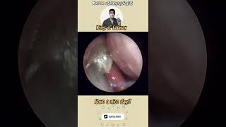 귀지형 콧물 부비동염 축농증 비염 코청소 이비인후과 rhinorrhea rhinitis sinusitis asmr ENT ENTdoctor [upl. by Celesta]