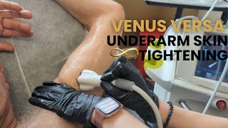 Venus Versa Underarm Skin Tightening Treatment [upl. by Truda694]