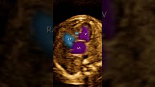 Fetal Ecocardiography Tricuspid atresia plus Ventricular septal defect [upl. by Nylarahs]