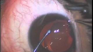 Implantable Collamer Lens Visian ICL implantation [upl. by Elleryt]