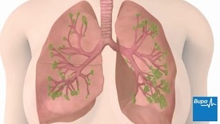 How chronic obstructive pulmonary disease COPD develops  Bupa Health [upl. by Cherry]