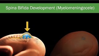 Fetal Spina Bifida Comprehensive Guide on Diagnosis Treatment amp Surgery [upl. by Bloch]