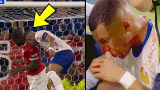 Kylian Mbappé Broken nose injury vs Austria😥💔 [upl. by Revorg]