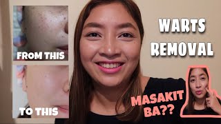 WARTS REMOVAL PH  TREATMENT AND HEALING PROCESS  SHYRA SANCHEZ [upl. by Htor]