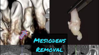 Black  White Version Mesiodens Removal from the Palate [upl. by Floyd]