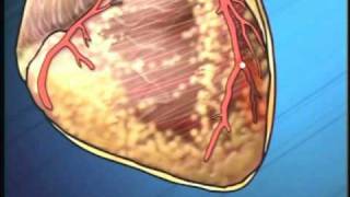 Periodontal Disease can cause Heart Disease Delray Beach Dentist [upl. by Nicolau]