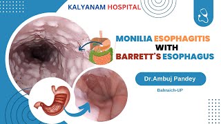 Monilial Esophagitis with Barretts Esophagus In Kalyanam Hospital Dr Ambuj Pandey Bahraich [upl. by Kraft]