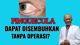 Apakah Pinguecula Bisa Disembuhkan Tanpa Operasi  dr Basuki Rokhmad SpM [upl. by Ahsatsana94]