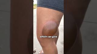 If you see this blister run 😨 viral [upl. by Kjersti904]