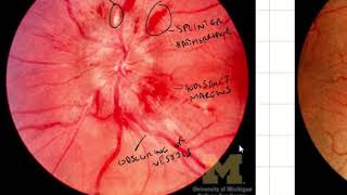 Papilloedema Fundoscopic Appearances [upl. by Ella]