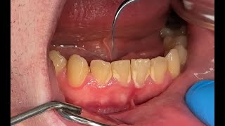 Dental scaling ASMR [upl. by Kilian790]