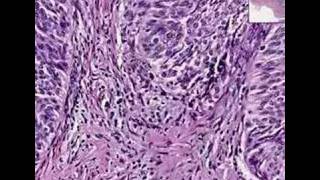 Histopathology Bladder Urothelial carcinoma Grade I [upl. by Enaud817]