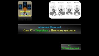 Ultrasound Case 77 Polysplenia Heterotaxy Syndrome [upl. by Rasmussen]