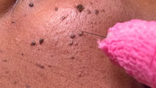 DPN Dermatosis Papulosa Nigra Removal [upl. by Kcinnay]