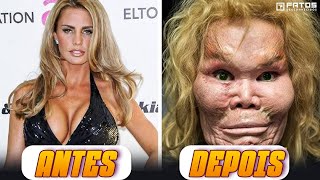 7 cirurgias plásticas em famosos que foram um desastre [upl. by Iruy]