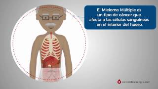 ¿Qué es el Mieloma Múltiple [upl. by Lilla]