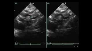 Echocardiography of Interrupted Aortic Arch [upl. by Noicpecnoc851]