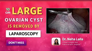 2022 Ovarian Cyst Signs and Symptoms  Scarless Laparoscopic Treatment  Dr Neha Lalla [upl. by Meng]