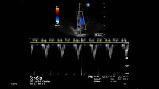 How to Measure LVOT VTI [upl. by Halima]