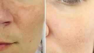 How to Remove Melasma from Face Permanently at Home [upl. by Atiloj]