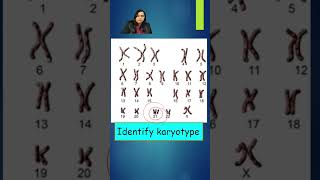 Karyotype Of Down Syndrome Pediatrics  Image based Diagnosis OSCE Spot  Shorts [upl. by Zednanref]