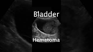 Bladder Hematoma pocus ultrasound emergencymedicine urology [upl. by Ittap141]