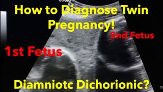 Twin Pregnancy  Diamniotic Dichorionic how to diagnose  easy steps [upl. by Leirad]