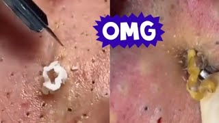 Top Acne Scar Treatments Proven Methods to Clear Your Skin Fast [upl. by Bambi]