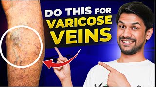 VARICOSE VEINS explained under 10 minutes  Saurabh Bothra Yoga [upl. by Nairolf]