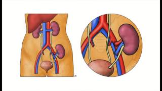 Kidney Transplantation  The Operation [upl. by Tierell]