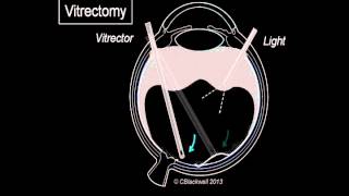 Vitreous 3 Vitrectomy Surgery [upl. by Ahcilef]