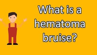 What is a hematoma bruise  Find Health Questions  Best Health TIPS [upl. by Robin]