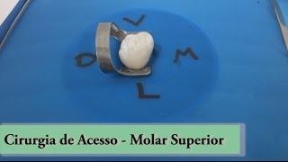 Molar Superior  Cirugia de Acesso [upl. by Anrev]