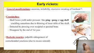 Rickets in children [upl. by Perdita267]