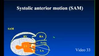 SAM  Systolic Anterior Motion in Feline Cardiomyopathy [upl. by Dari942]