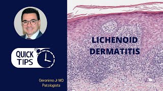 LICHENOID DERMATITIS PART I [upl. by Nylatsirhc]