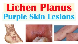 Lichen Planus “Purple Skin Lesions”  Causes Signs amp Symptoms Diagnosis Treatment [upl. by Anirba693]