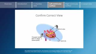 Key screening views of the fetal heart  Part 4  Left ventricular outflow [upl. by Burwell503]