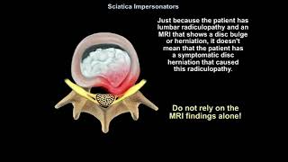 Sciatica Impersonators Explained Top Causes Symptoms and Treatments You Must Know [upl. by Ialda]